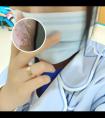 局部白点癫风可以根治吗