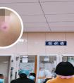 晕痣抹什么药膏效果好一点