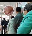 白点癫风会引起什么并发症