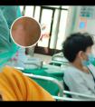 308准分子光照黑的位置是什么